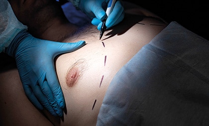 Gynecomastia-05-1