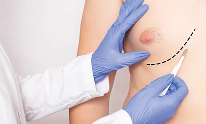 Gynecomastia-06-1