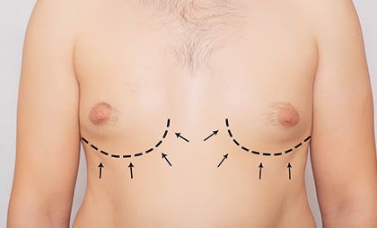 Gynecomastia-9