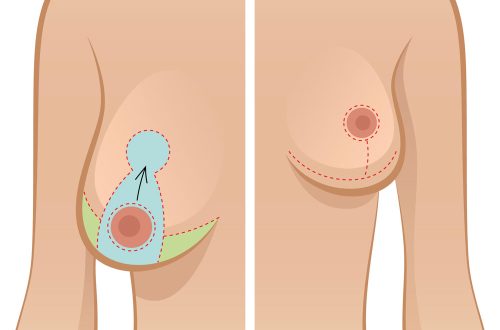 breast-reduction-and-breastfeeding-4w